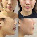 씨유 건대한림타워점 | 건대피부관리 ｜ 약손명가 건대점 양악관리 1회차 후기