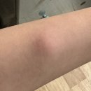 양성한의원 | 팔 전완(하완) 신경초종 이야기 - 발견, 증상, 진료, 치료, 후기