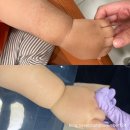 아기 밀크반점 레이저치료 20회차 후기(전후사진 비교)