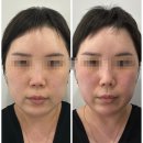 안녕 | 인천 구월동 온다 후기 심부볼 턱살 이제는 안녕!