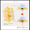 추간판탈출증(디스크) 예방[올바른 자세 및 운동치료가 매우 중요] 이미지