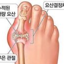 통풍의 원인과 증상 퓨린이 많은 음식 요산 수치 이미지