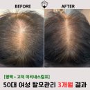 미리내스칼프 | 평택 여성탈모 두피관리, 3개월 후 정수리 변화는? (미리내스칼프 실제 후기)