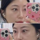 씨리커피 | 부산 하단 눈밑지방재배치 수술 솔직후기 : 당일~일주일 붓기,멍 변화과정