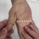 서초베스트외과의원 | 서초베스트외과의원> 손바닥 열린 상처 봉합
