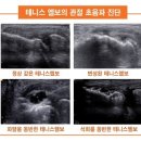 [테니스엘보치료] 파열된 인대를 자꾸 사용하면... 이미지