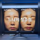 청주 피부관리::드나비 청주점 율량동 버블 리프팅관리 후기