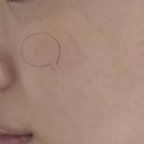 제이약국 | 주근깨 제거 일주일 리얼 후기 : 일산백석 제이뷰티 클레어