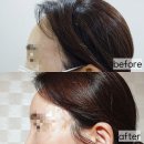 세영빌딩 | 수원 연세플러스의원 이마, 관자 필러 후기 (효과, 용량, 가격, 부작용)