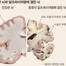 치매 증상 자가 진단 방법 종류 건망증 차이점 예방법 이미지