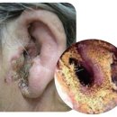 포낙보청기 이미지