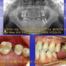 SAS를 이용한 molar uprighting 이미지
