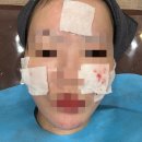 임한의원 | 노원한의원추천 패인흉터 새살침 내돈내산 후기 1회차