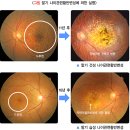 황반변성 원인, 증상, 예방 및 치료방법(feat. 루테인, 지아잔틴의 효과 및 풍부한 음식)