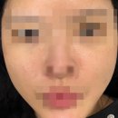부산서면피부과 롯데호텔피부과 롯데백화점피부과 온다리프팅 내돈내산 후기