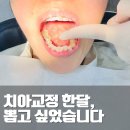 잠실 치아교정 한달 후기 처음 철사 교체 및 발치한 날 후회된다(ft. 40대)