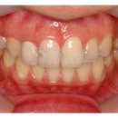 치아성형 & 라미네이트비용 오래된 보철물과 앞니 충치의 라미네이트 치아성형 치료 이미지