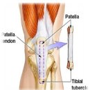 [십자인대,관절내시경] 십자인대 파열시 치료방법은?-＞관절내시경 수술 이미지