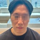 부산흉터치료잘하는곳 새살침 2회차+레가토 시술 솔직 후기!