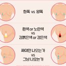 유방 상피내암, 제자리암 및 (초기 유방암 0기, 유두 습진, 분비물) 이미지