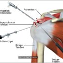 어깨회전근개파열 관절수술도 역시 관절경수술잘하는곳 여기 이미지
