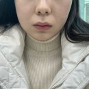 수원피부과 얼굴 지방분해주사 라리컷V주사 이중턱 고민해결 후기