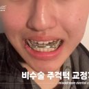 강남 성인 주걱턱 교정 치과, 18개월만 턱 없앤다!
