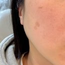 병원1 | 창원 흑자제거 내돈내산 시술 후기 1. 병원 비교 상담후기