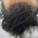 이안메디칼 | 부천SMP 잘하는 곳 <누아블랑> 부천탈모커버 남자M자탈모 탈출!