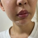 한그루치과병원 | 잇몸 염증이 너무 심해서 결국 치근단절제수술을 하다.🦷😬🪥