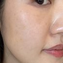 최한의원 | 부산모공관리 해운대 피부한의원 &#39;모공컨택터&#39; 스킨부스터 받고 온 3회차 솔직후기