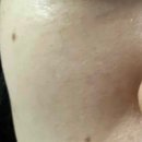 우리의원 | [우리맑은의원] 점 제거 시술 후기