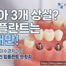 범어강치과의원 | 수성구 임플란트, 치아 3개 없어도 2개만 심는다? 비용 줄이는 임플란트 브릿지 총정리
