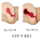 에이비알(ABR) | 제왕절개 산후출혈(PPH) 유도분만 응급실 방문