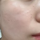 루미에의원 | 루미에의원 :: 강남역 엑셀V레이저 프리미엄 후기