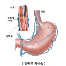 하지정맥류에 대한 혈관마사지의 위험성 이미지