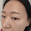 율한의원 | (여드름흉터치료) 천안여드름전문한의원 새살침 3회차 율각테라피 2회차 상태 찐후기 새살약침1회 포함