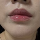 노원약국 | 노원 피부과 입술 점 빼기 후기, 제거 가격 (입술 점 관상)