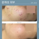 신 기 | 예민한 피부엔 이거 하나면 끝! 리라신 스팟 솔루션 사용 후기