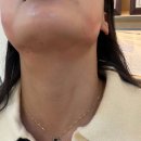 바로서면병원 (급식소포함) | 서면 TT주사 윤곽주사 2주차 내돈내산 현실 후기