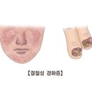 결절성 경화증 (Tuberous Sclerosis) 이미지