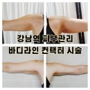 (주)제이더스화학 | 강남역 피부과 예신 팔뚝살 관리 추천 지분주 일주일 후기