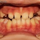 매곡가족치과교정과치과의원 | 돌출입교정치과 아래턱넣기 반대교합교정후기