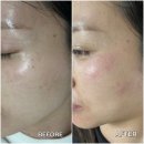 강남 역삼역 기미 잡티 제거 &#39;미작뷰티 강남본점&#39; 솔직 후기