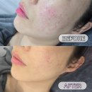 김은영스킨케어 | [서울/신촌] 문제성피부 압출 맛집 에스테틱 김은영 코스메틱 3개월 내 돈 내산 후기