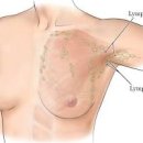 왼쪽 겨드랑이 통증 임파선염 진단 예방 이미지