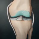 무릎 관절염, 더 이상 아프지 마세요! 2025년 연골 주사/인공 관절 효과&amp;부작용/수술 전후 관리