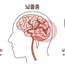 병력과 신경학적 검사결과 일치(열공성뇌경색진단비 인정기준)(운동마비, 감각마비,안구운동마비, 시야결손) 이미지