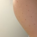 [강남/압구정] 닥터손유나의원 매직팔뚝캣 1회차 내돈내산 솔직 후기, 여름 팔뚝 준비, 팔 안쪽 살 부셔...