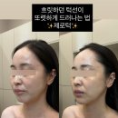 오송피부관리 프롬더윤에스테틱에서 이중턱 관리 후기